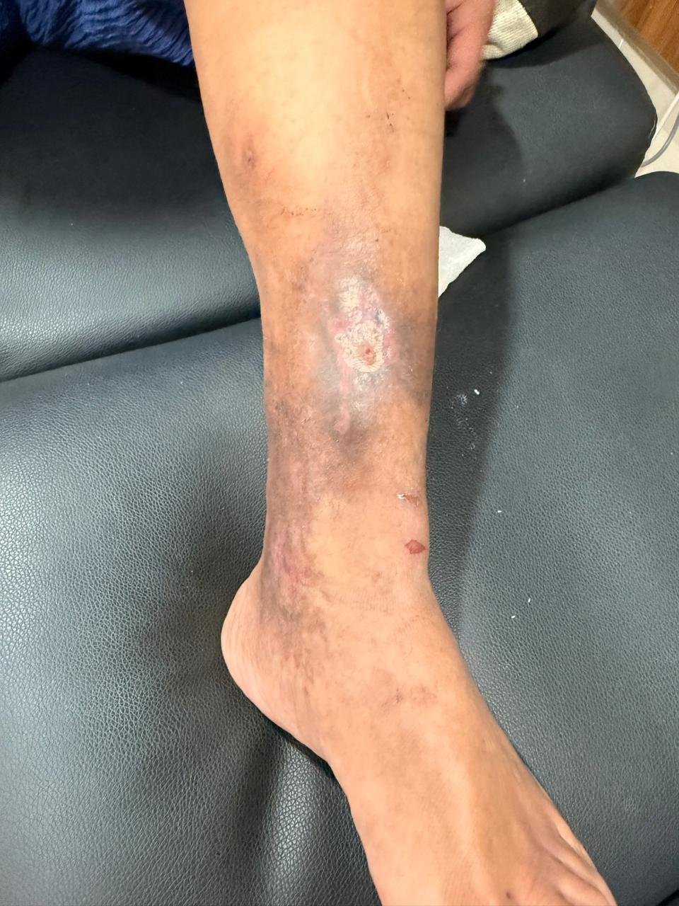 Pierna después del tratamiento de úlcera venosa